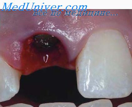 Лечение дефекта коронковой части зуба thumbnail