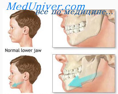 Классификация переломов верхней челюсти по энтину thumbnail
