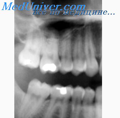 рентгенография в стоматологии