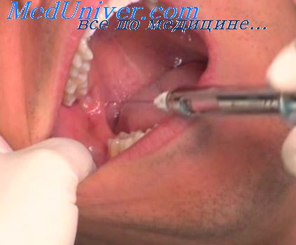 мотыжка в стоматологии