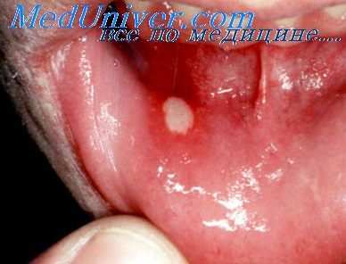 Жалобы при аллергическом стоматите на акриловые пластмассы thumbnail