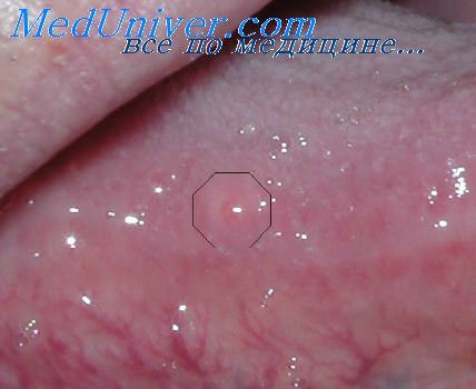 Гемангиомы в полости рта. Обзор клинического случая