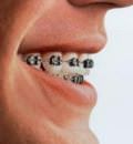 аномалии положения зубов