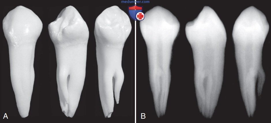 3 корневых каналов. Премоляры верхней челюсти рентген. Премоляр верхней челюсти эндодонтия. Второй верхний премоляр рентген.