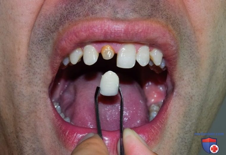 Цены на протезирование зубов через имплантацию под ключ
