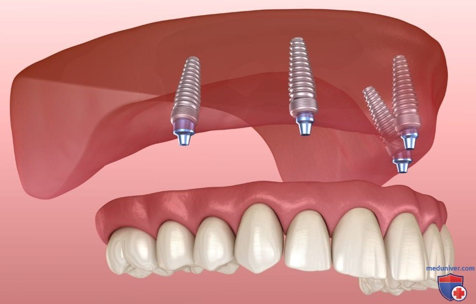 Цены на протезирование зубов через имплантацию под ключ