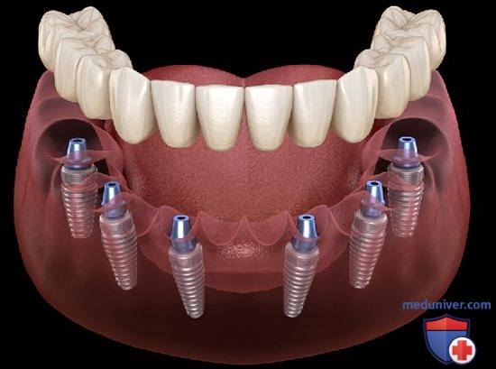 Имплантация зубов all-on-6