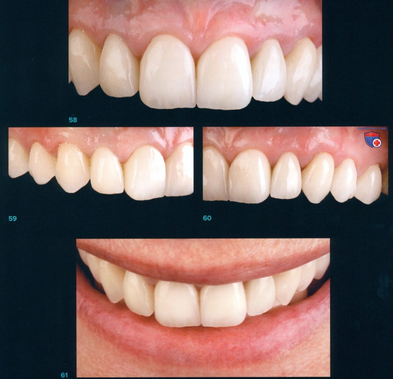 реставрация передних зубов фото