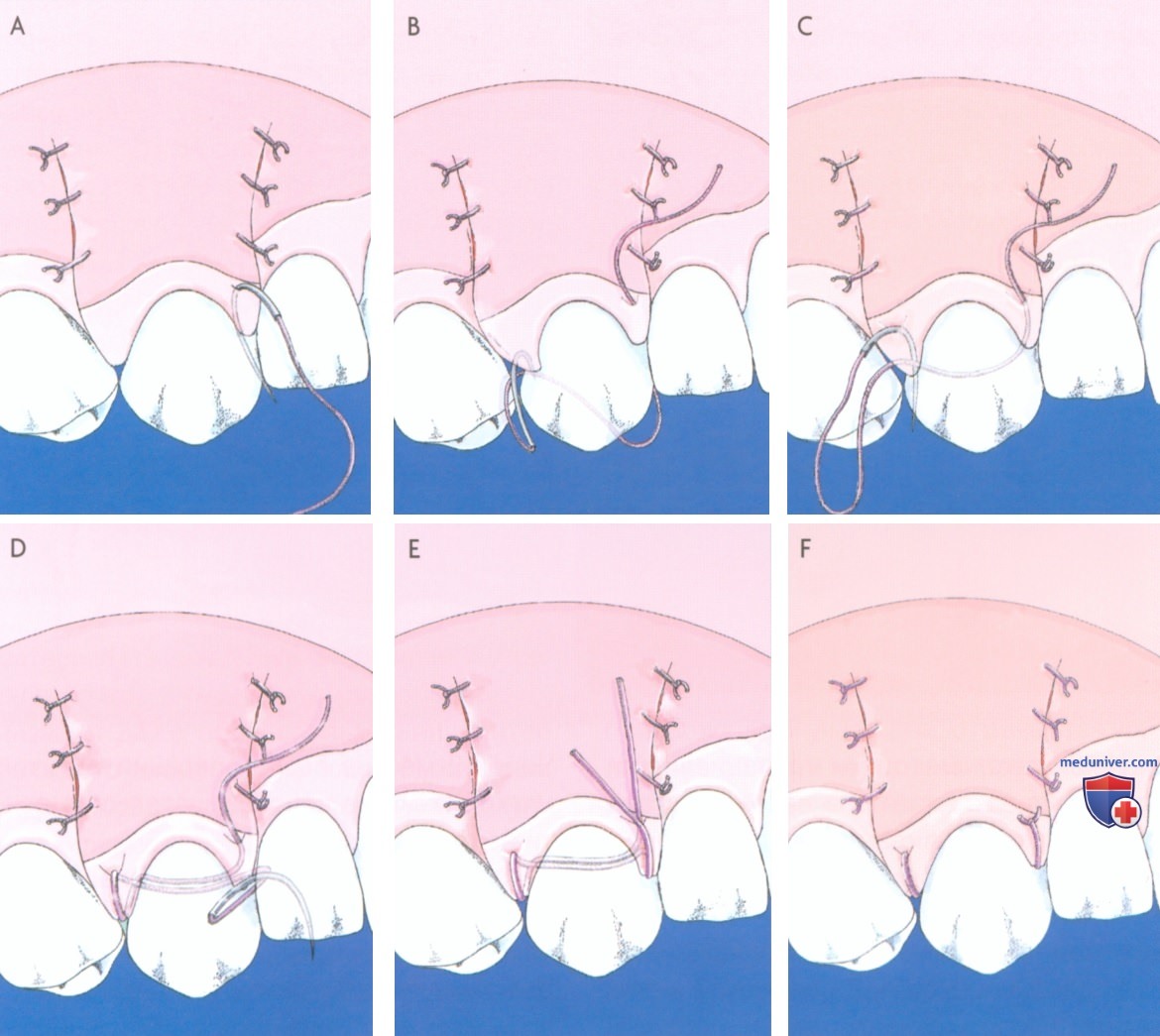 Протокол операции коронального смещения трапециевидного лоскута с послабляющими разрезами по поводу щели между десен (рецессии десны)