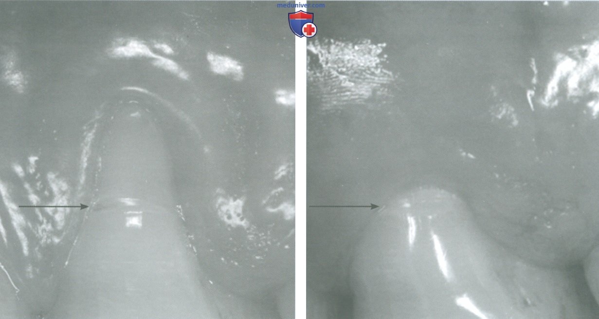 Протокол операции коронального смещения трапециевидного лоскута с послабляющими разрезами по поводу щели между десен (рецессии десны)