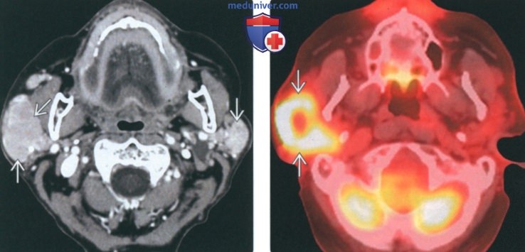 КТ, МРТ при неходжкинской лимфоме околоушной железы