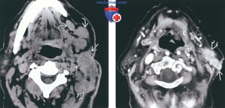 КТ, МРТ при метастазах в околоушную железу