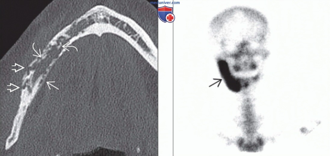 КТ, МРТ, сцинтиграфия при остеомиелите челюсти