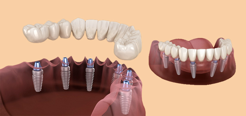 Методы имплантации зубов All-on-4 и All-on-6 (все на 4 или 6 имплантах)
