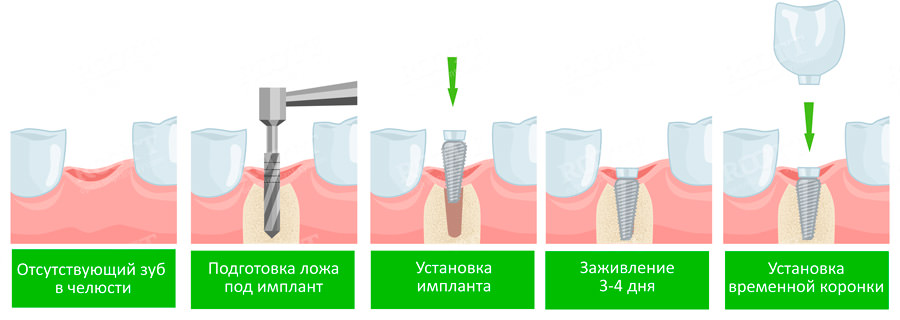 одноэтапная имплантация зубов