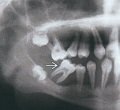 Рентгенограмма при парящих зубах