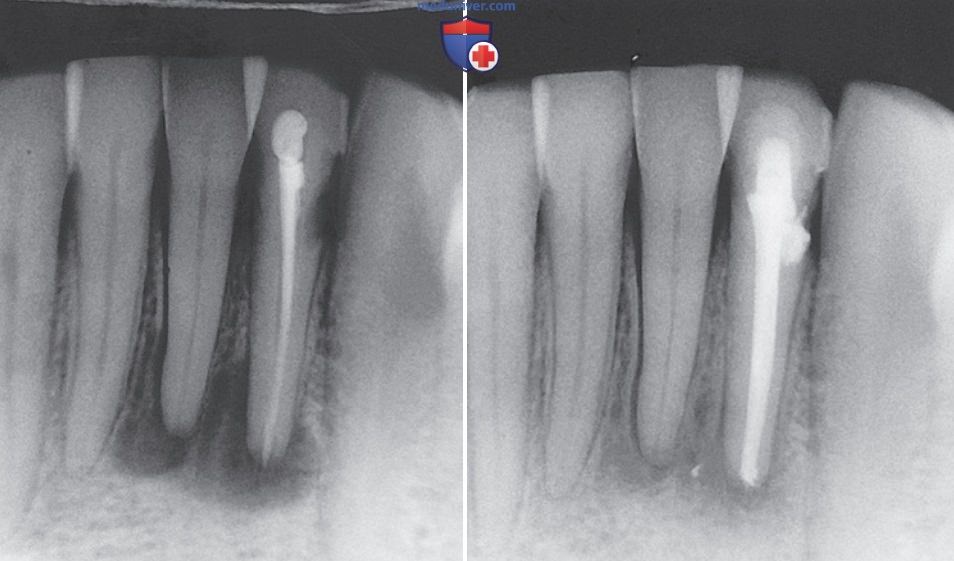 После эндодонтического лечения. Эндодонтическое зеркало. Рентгенологический снимок зуба 36. Современные методы эндодонтического лечения временных зубов. Протокол эндодонтического лечения зубов.