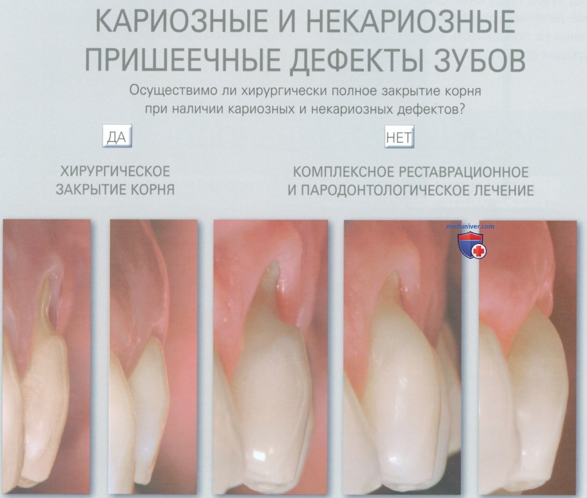 воспаление десны зуба фото