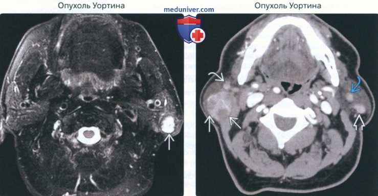Аденома околоушной слюнной железы (лечение в Киеве) | Мед-Део