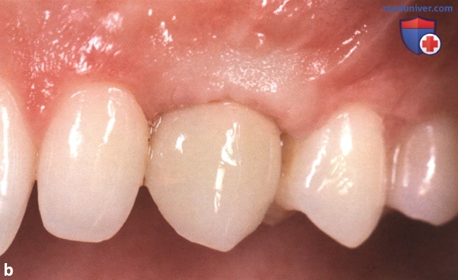 ������� ������ ������ � ������� ������� ��� ����������� � ������� �������� �����