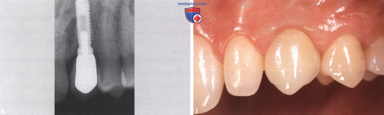 ������� ������ ������ � ������� ������� ��� ����������� � ������� �������� �����