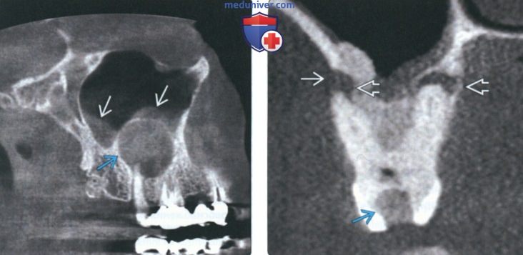 Заболевания тканей периапикальной части зуба