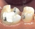 Штифтовые культевые конструкции (ШКК) для восстановления депульпированных зубов