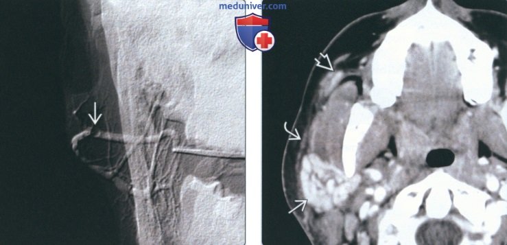 Лучевая диагностика сиалолита околоушной железы