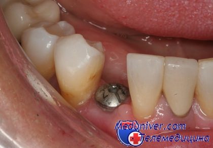 снятие отека после имплантации зуба