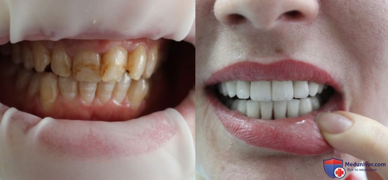 Реставрация зубов установкой виниров