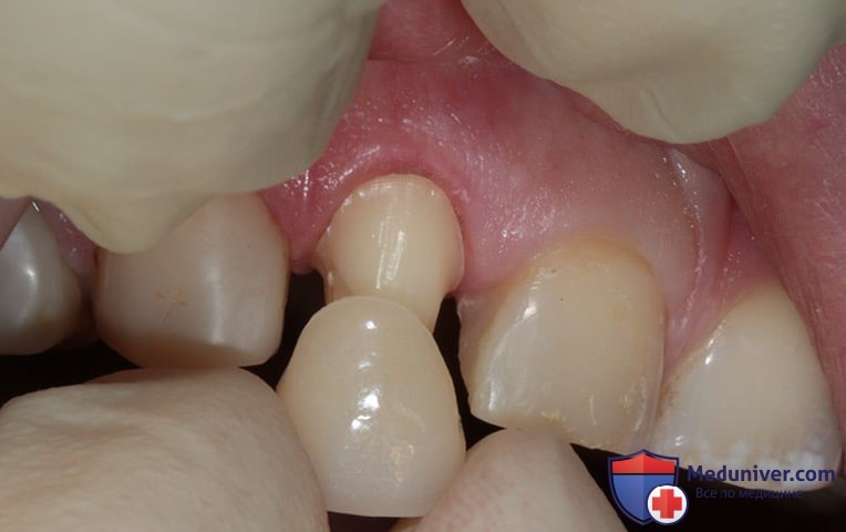 Реставрация зуба путем его шлифовки под коронку и ее установки