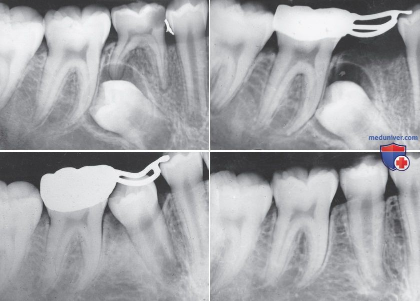 Молочная пятерка зуб. Рентген молочных зубов. Распорка для молочных зубов.