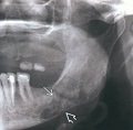 Рентгенограмма при уменьшении мыщелка височно-нижнечелюстного сустава (ВНЧС)