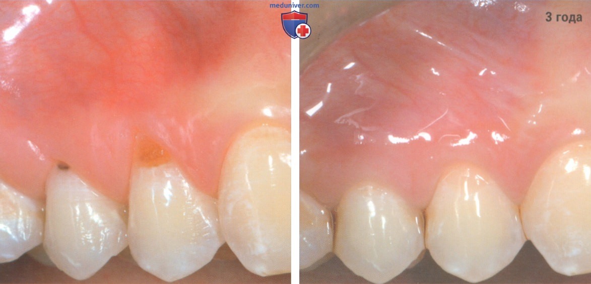 Операция при рецессии десны из-за кариеса корня зуба корональнее и апикальнее уровня МЗК