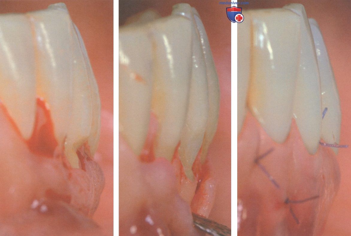 Операция при рецессии десны из-за пришеечного кариеса зуба корональнее уровня максимального закрытия корня (МЗК)