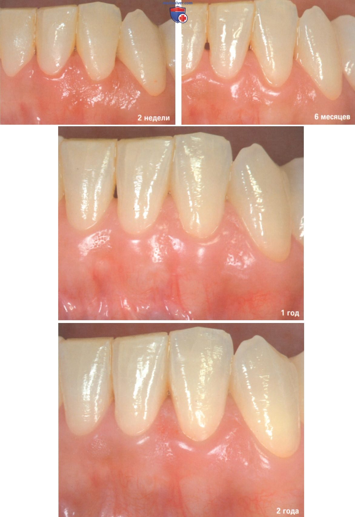 Операция при рецессии десны из-за пришеечного кариеса зуба корональнее уровня максимального закрытия корня (МЗК)