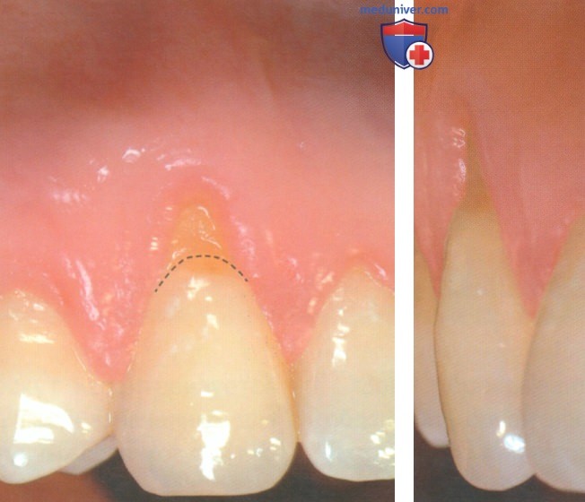 Операция при рецессии десны из-за кариеса корня зуба апикальнее уровня максимального закрытия корня