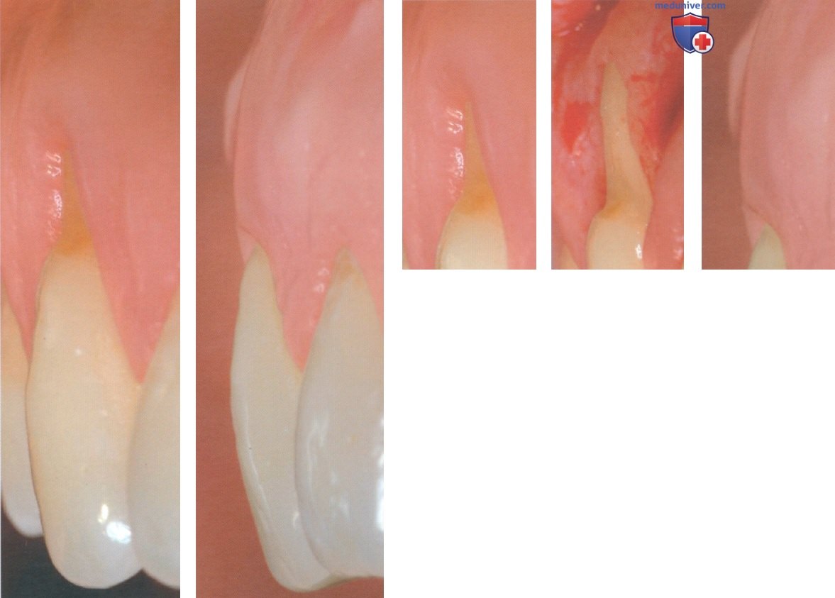Операция при рецессии десны из-за кариеса корня зуба апикальнее уровня максимального закрытия корня