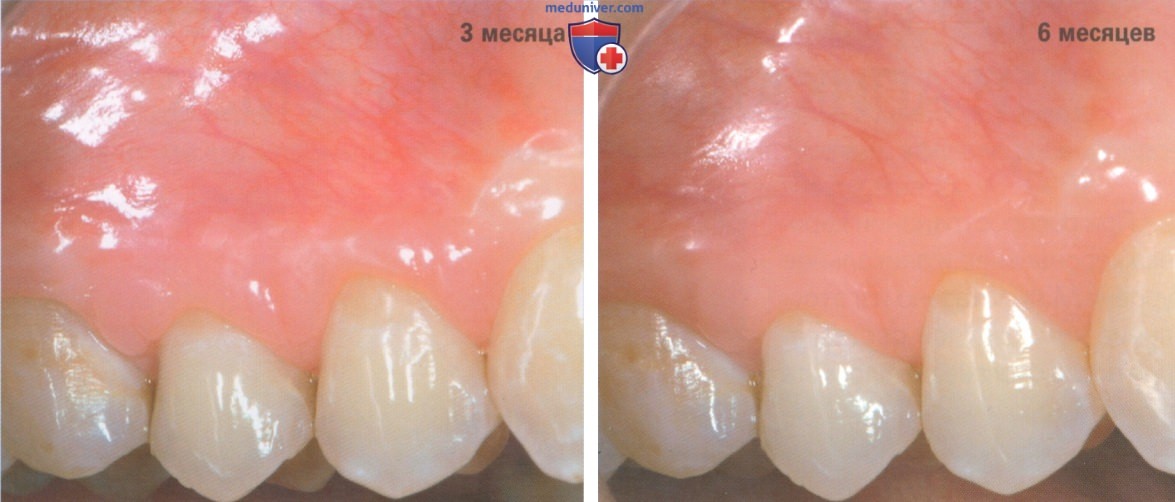 Операция при рецессии десны из-за кариеса корня зуба корональнее и апикальнее уровня МЗК