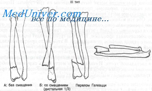 Переломы диафиза лучевой кости