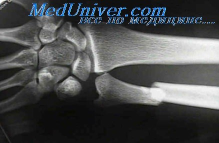Диафизарные переломы локтевой кости thumbnail