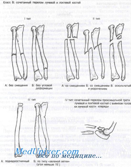 сочетанные переломы лучевой и локтевой костей