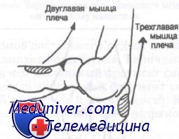 перелом дистального отдела лучевой кости