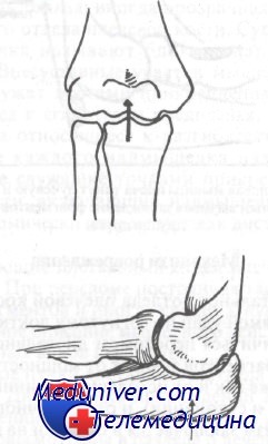 перелом дистального отдела лучевой кости