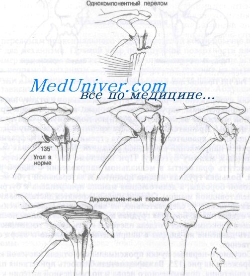 переломы проксимального отдела плечевой кости