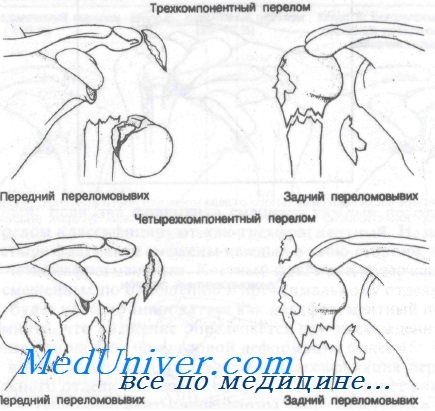 Классификация перелом плечевой кости thumbnail