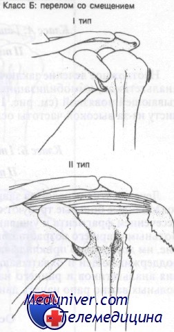 Перелом большого бугорка плечевой кости механизм образования thumbnail