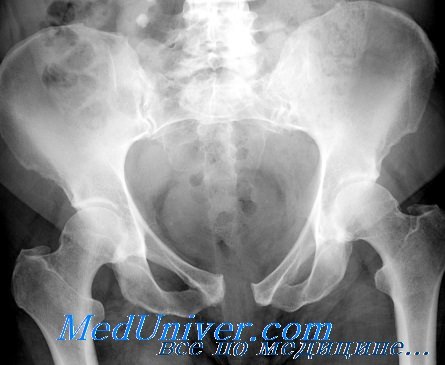 рентгенография костей таза при переломе