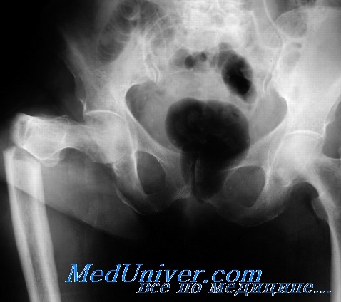 Перелом шейки бедренной кости травматология thumbnail