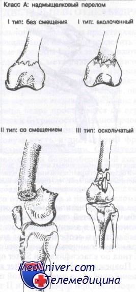 Классификация переломов дистального отдела бедренной кости thumbnail